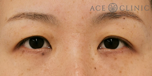 谷院長-眼瞼挙筋前転法症例