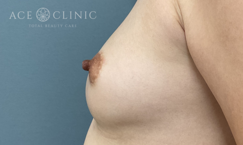 乳頭縮小症例-中山医師