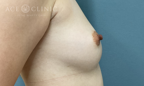 乳頭縮小症例-中山医師