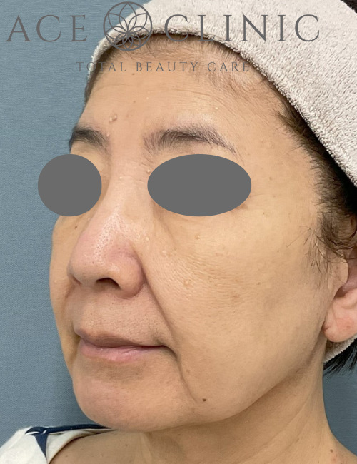 糸リフト症例-中山医師