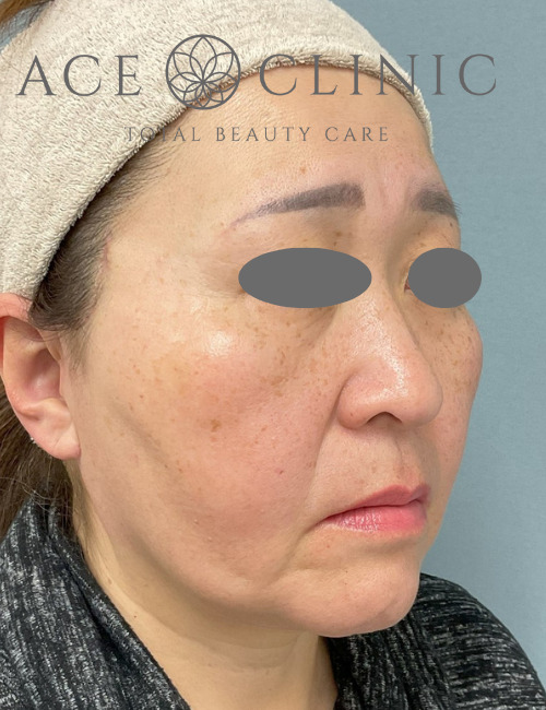 MACSリフト｜症例2｜術後｜エースクリニック大阪梅田HEPナビオ院