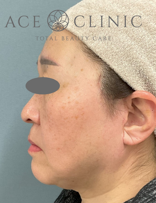 MACSリフト｜症例2｜術後｜エースクリニック大阪梅田HEPナビオ院