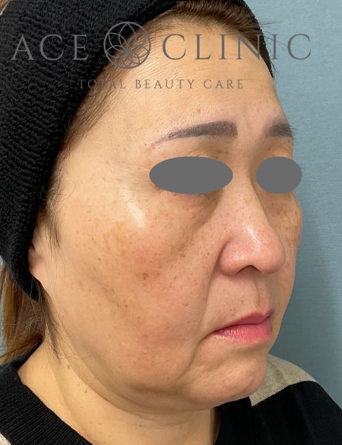 MACSリフト｜症例2｜術前｜エースクリニック大阪梅田HEPナビオ院