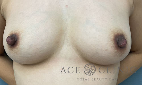 乳頭縮小－宇根医師