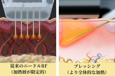 従来のニードルRFとブレッシングのRF照射方式の違い