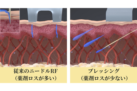 従来のニードルRFとブレッシングのドラッグデリバリー機構の違い