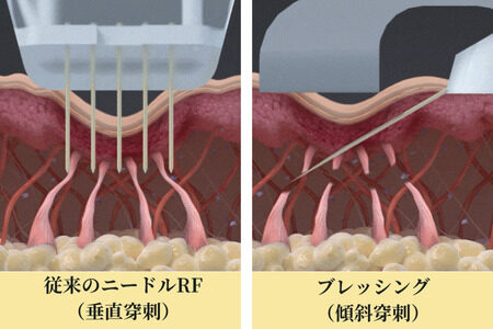 従来のニードルRFとブレッシングのニードル構造の違い