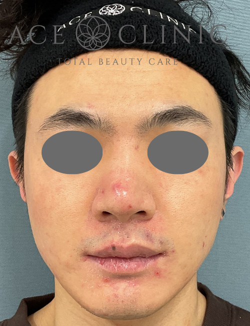 アドバテックスレーザー-dr.中山