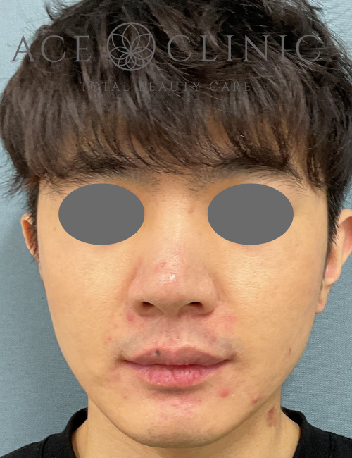 アドバテックスレーザー-dr.中山