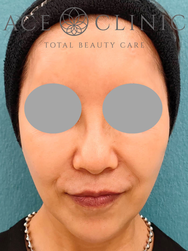 アドバテックスレーザー｜症例1｜60代女性｜施術後　正面｜エースクリニック大阪梅田院