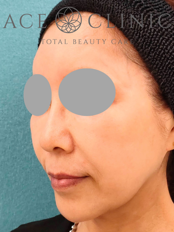 アドバテックスレーザー｜症例1｜60代女性｜施術後　左斜め｜エースクリニック大阪梅田院