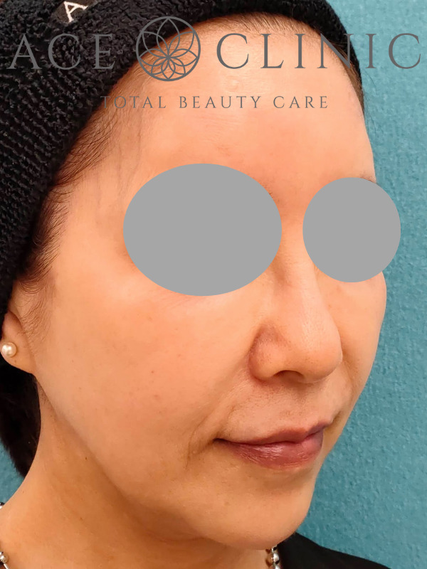 アドバテックスレーザー｜症例1｜60代女性｜施術後　右斜め｜エースクリニック大阪梅田院