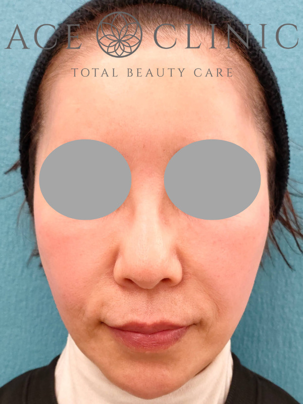 アドバテックスレーザー｜症例1｜60代女性｜施術前　正面｜エースクリニック大阪梅田院