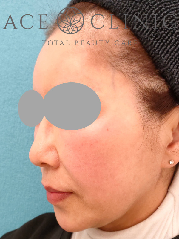 アドバテックスレーザー｜症例1｜60代女性｜施術前　左斜め｜エースクリニック大阪梅田院