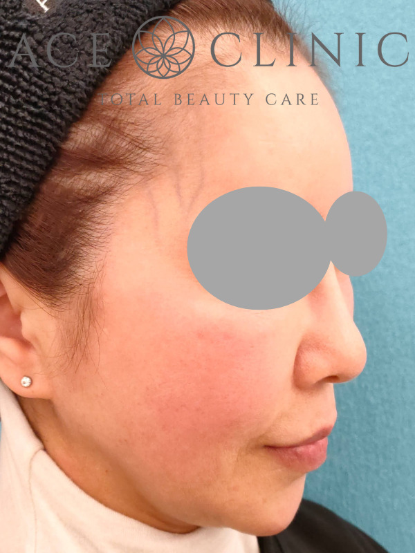 アドバテックスレーザー｜症例1｜60代女性｜施術前　右斜め｜エースクリニック大阪梅田院