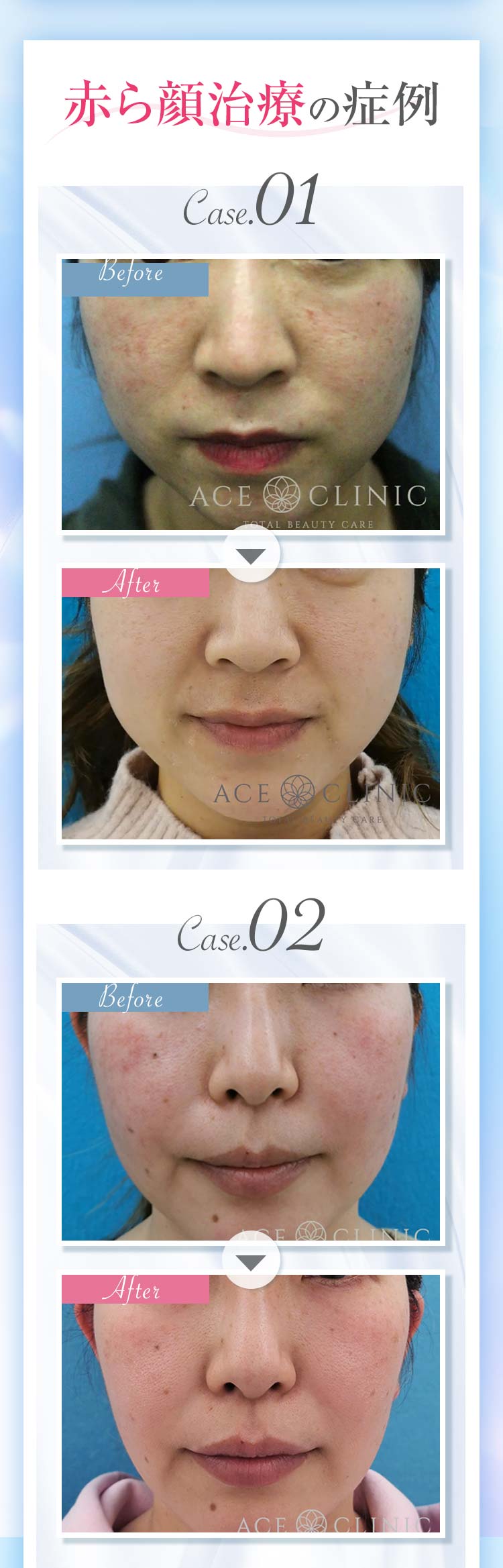 赤ら顔治療の症例1 2