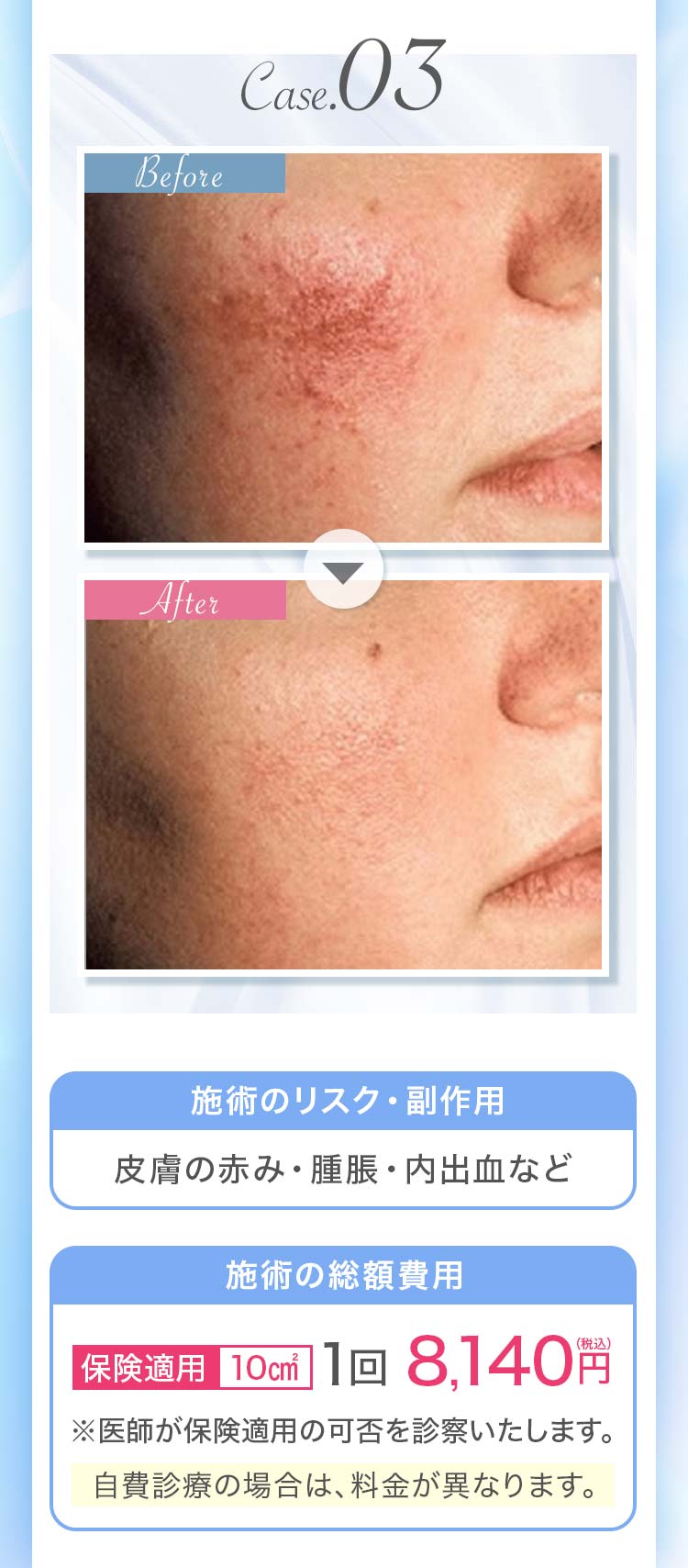 赤ら顔治療の症例3 料金