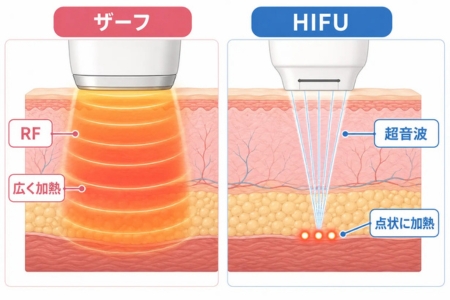 ザーフとHIFUの熱の入り方の違い