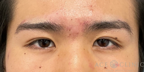 二重埋没法｜症例58｜男性｜術後1ヶ月｜エースクリニック大阪梅田HEPナビオ院