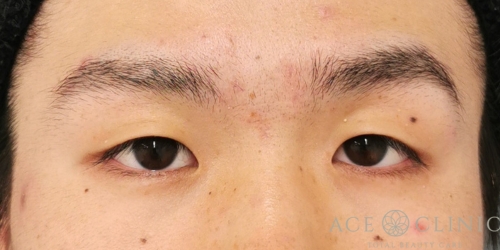 二重埋没法｜症例58｜男性｜術前｜エースクリニック大阪梅田HEPナビオ院