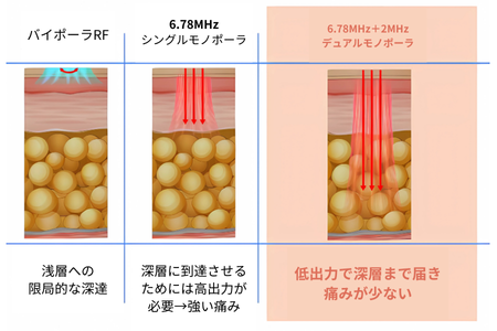 デュアルモノポーラRFの熱の入り方