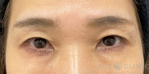 眼瞼下垂｜症例102｜50代女性｜術後1ヶ月｜エースクリニック大阪梅田HEPナビオ院
