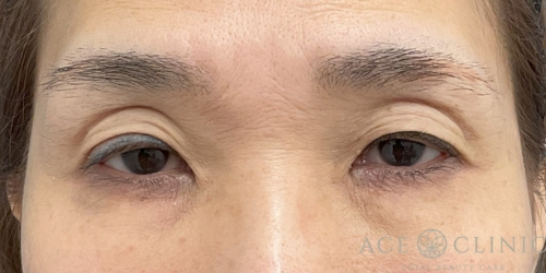 眼瞼下垂｜症例102｜50代女性｜術前｜エースクリニック大阪梅田HEPナビオ院