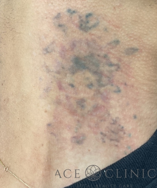 タトゥー除去｜症例27｜術後｜照射6回｜エースクリニック大阪梅田HEPナビオ院