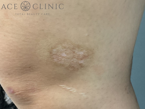 タトゥー除去｜症例28｜術後｜照射6回｜エースクリニック大阪梅田HEPナビオ院