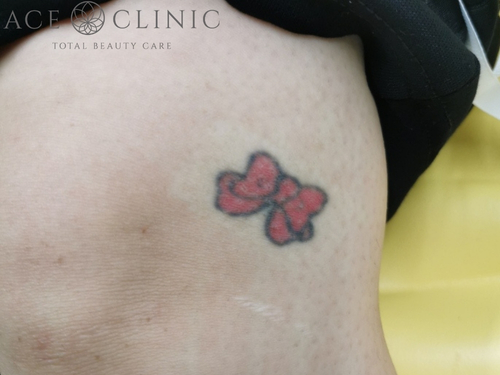 タトゥー除去｜症例28｜術前｜エースクリニック大阪梅田HEPナビオ院