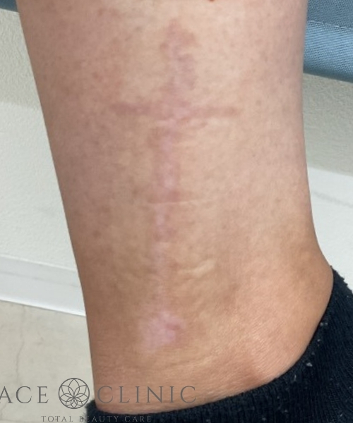 タトゥー除去｜症例29｜術後｜照射9回後｜エースクリニック大阪梅田HEPナビオ院