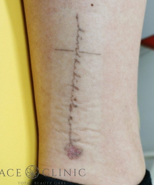 タトゥー除去｜症例29｜術前｜エースクリニック大阪梅田HEPナビオ院