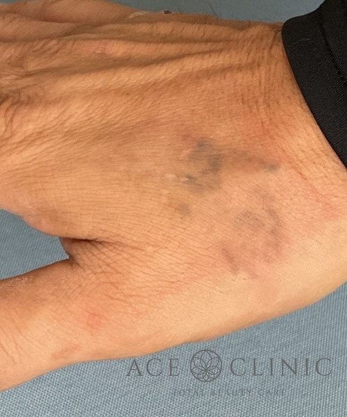 タトゥー除去｜症例30｜術後｜照射5回後｜エースクリニック大阪梅田HEPナビオ院