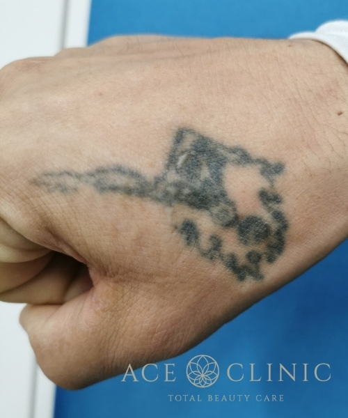 タトゥー除去｜症例30｜術前｜エースクリニック大阪梅田HEPナビオ院