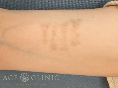 タトゥー除去｜症例31｜術後｜照射6回後｜エースクリニック大阪梅田HEPナビオ院