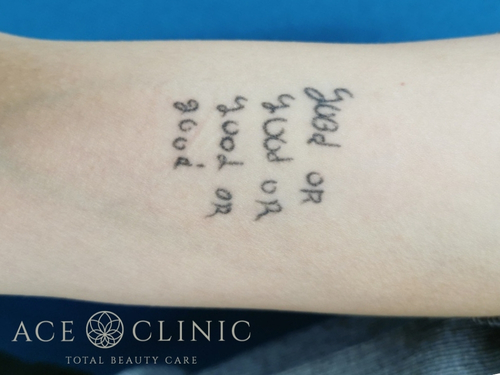 タトゥー除去｜症例31｜術前｜エースクリニック大阪梅田HEPナビオ院