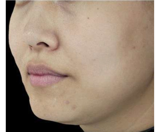 ザーフ｜症例1｜施術前｜【エースクリニック】大阪梅田HEPナビオ院