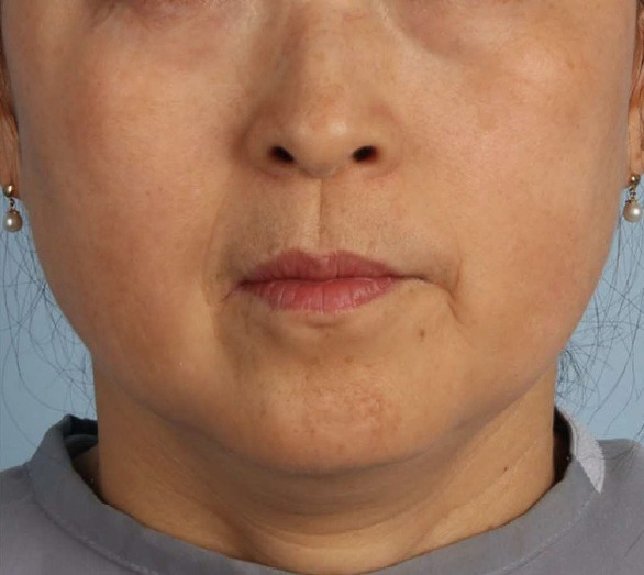 ザーフ｜症例2｜施術後｜【エースクリニック】大阪梅田HEPナビオ院