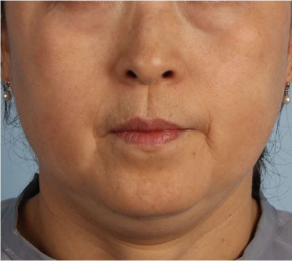 ザーフ｜症例2｜施術前｜【エースクリニック】大阪梅田HEPナビオ院