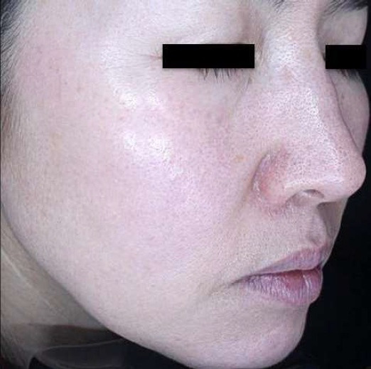 ザーフ｜症例3｜施術後｜【エースクリニック】大阪梅田HEPナビオ院