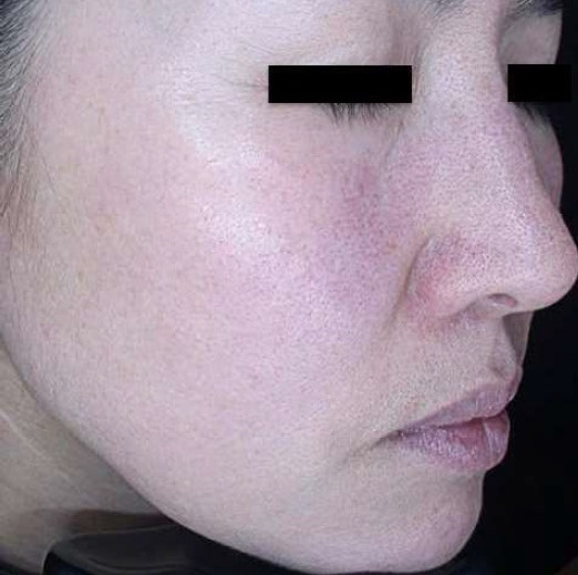 ザーフ｜症例3｜施術前｜【エースクリニック】大阪梅田HEPナビオ院