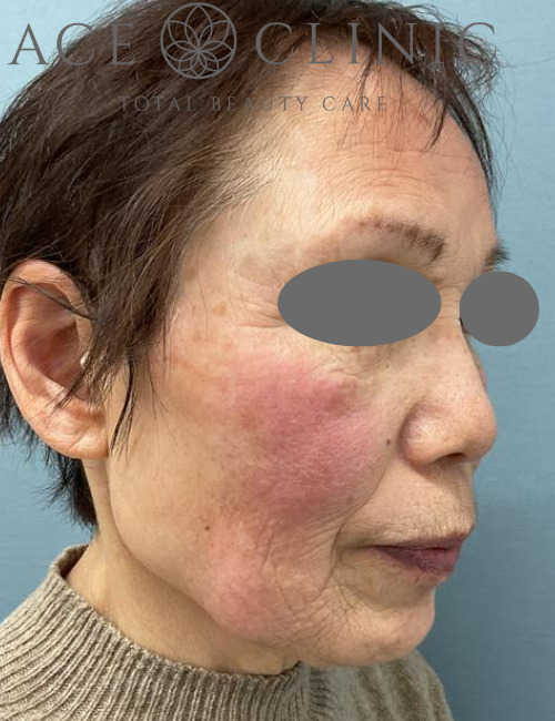 アドバテックスレーザー症例