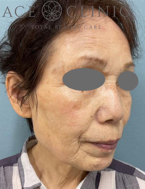 アドバテックスレーザー症例