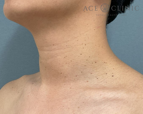 アクロコルドン(首いぼ)炭酸ガスレーザー症例