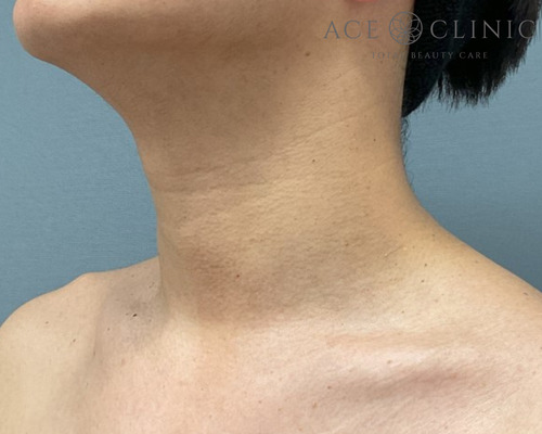 アクロコルドン(首いぼ)炭酸ガスレーザー症例