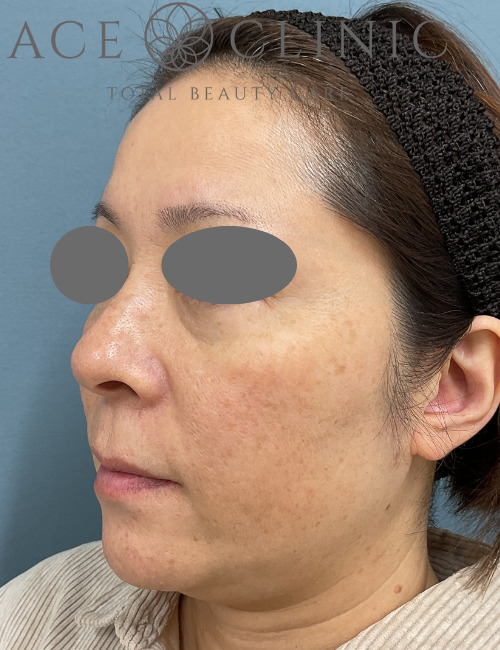 ルビーレーザー症例