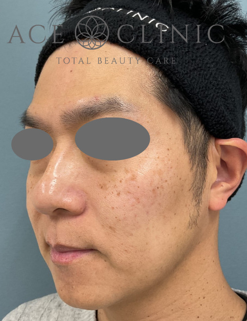 ルビーレーザー症例