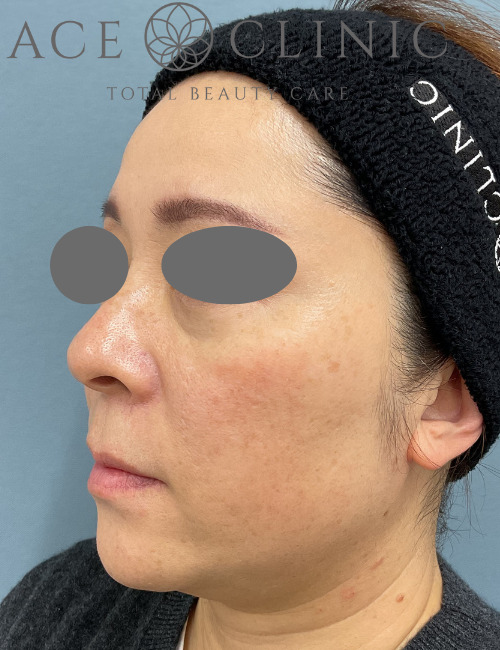 ルビーレーザー症例