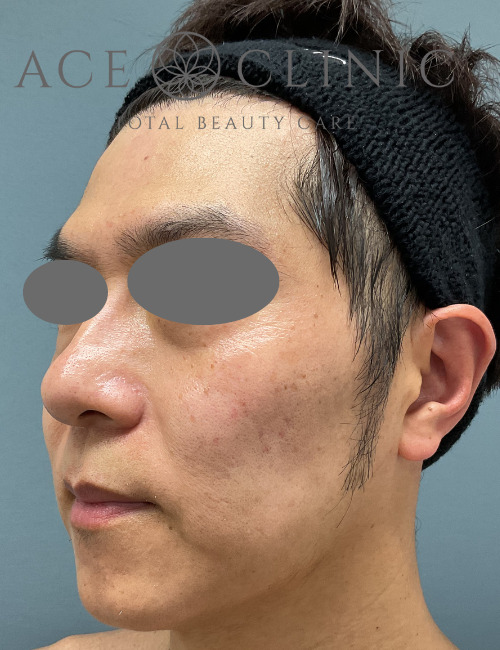 ルビーレーザー症例