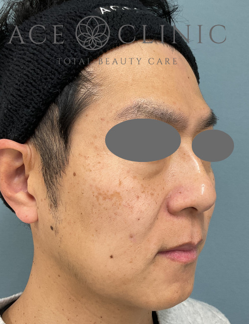 ルビーレーザー症例